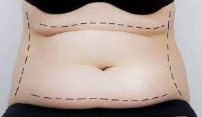How to Choose an Abdominoplasty Clinic in Miami post thumbnail image